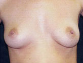 Patient # 20422 Before Photo # 1